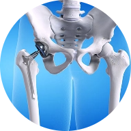 Hip Arthroscopy