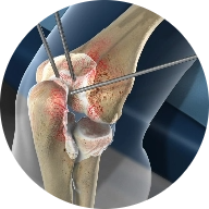 Elbow Arthroscopy