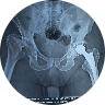 HIP Replacement Surgeries