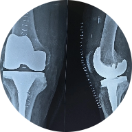 Knee Replacement